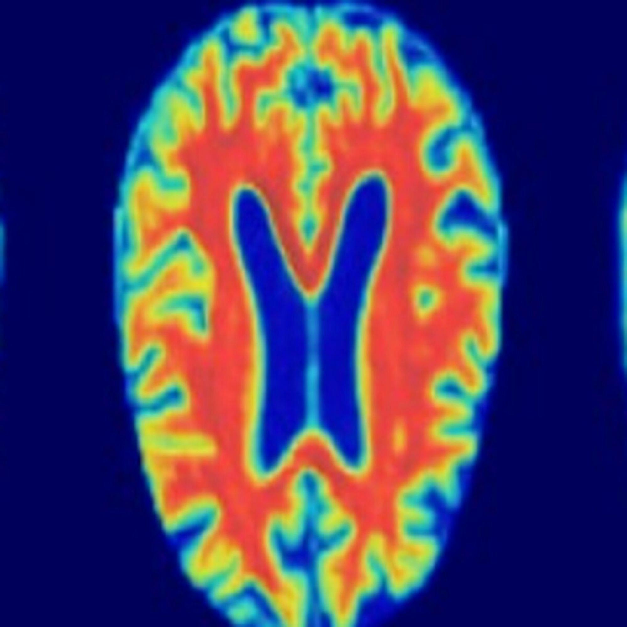 Alzheimer MRI Preprocessed Dataset